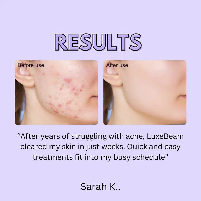 Dual Light Acne Therapy - The Next Door Neighbor 