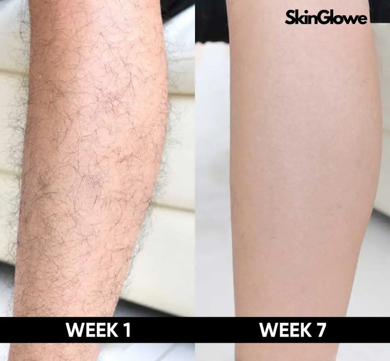 Perm Laser Hair Removal
