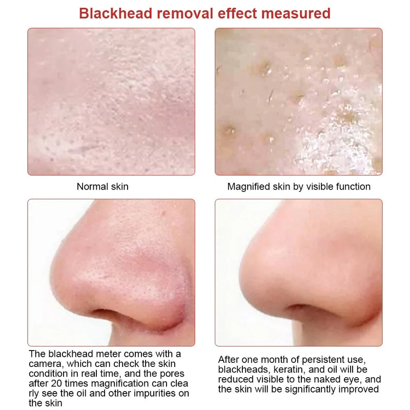 Blackhead Remover Vacuum Suction with Camera - The Next Door Neighbor 