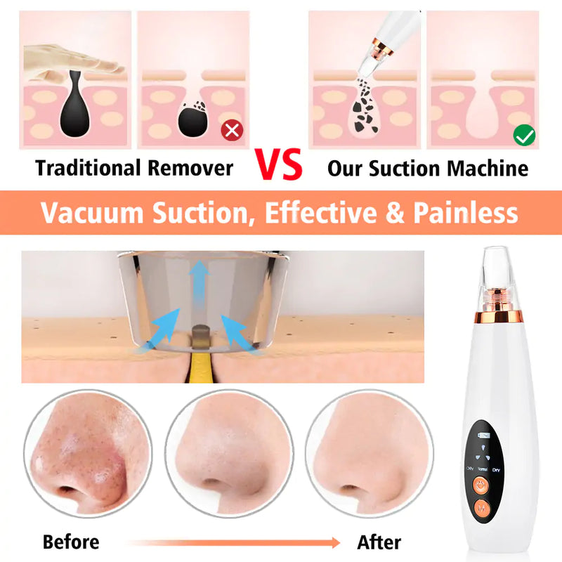 Electric Blackhead Removing Device - The Next Door Neighbor 